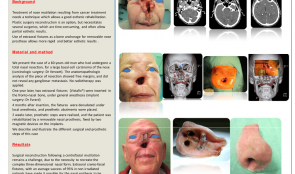 REHABILITATION OF A PATIENT WITH NOSE MUTILATION RESULTING FROM CARCINOLOGIC SURGERY USING EXTRAORAL FIXTURES AND EPITHESIS