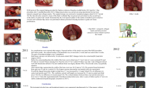 ALVEOLAR RIDGE PRESERVATION IN DAMAGED SITE 4.7—AN EARLY STAGED OPEN-HEALING PROTOCOL IN HIGH-RISK PATIENTS TREATED WITH ORAL BISPHOSPHONATES