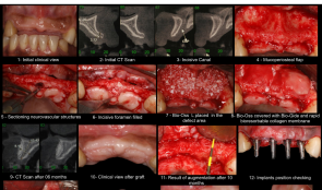 RIDGE AUGMENTATION BY APPLYING DEPROTEINISED BOVINE BONE MINERAL (DBBM) AND BIORESORBABLE MEMBRANE—A CASE REPORT