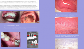 ENDOIMPLANTIASIS: DESCRIPTION OF THE CLINICAL ASPECT, RADIOGRAPHIC, HISTOLOGIC, IMMUNOHISTOCHEMICAL AND MICROBIOLOGICAL – A CASE SERIES