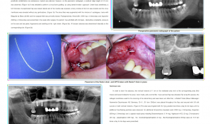 TECHNICAL NOTE ON THE MANAGEMENT OF POSTOPERATIVE INFECTIONS AFTER SINUS BONE GRAFTING—SINUS LIFT RESCUE