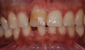 Central incisor implant