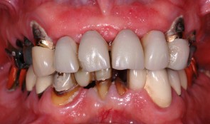 Complex rehabilitation with a overdenture