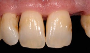 Immediate Implant placement in the esthetic area