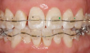 Complete periodontal treatment by Dr. Sanz Martin