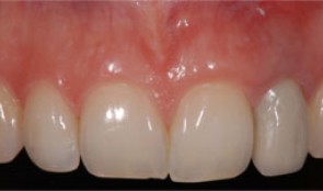 Hopeless lateral incisor in a young patient
