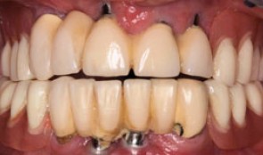 Complete rehabilitation of a cleft patient