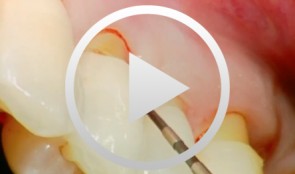 YAG Laser Applications