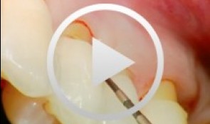Er: YAG Laser in der Praxis
