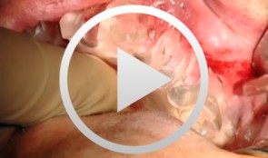 Sinus Bone Augmentation with PRP