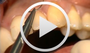 Esthetic Periodontal Treatment with Microsurgical