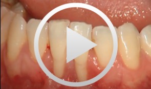 Verbreiterung der attached keratinisierten Gingiva durch ein freies Schleimhautimplantat