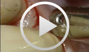 Access-Flap for Treatment of Aggressive Periodontitis