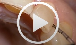 Minimalinvasive Parodontitistherapie (Chirurgische Rezidivbehandlung)