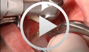 Implant-borne Immediate Prothesis on Laser-Welded Bar