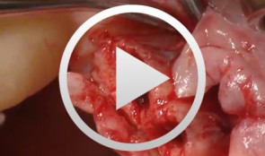 Bone Spreading, Bone Condensing