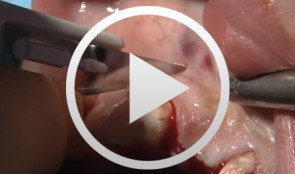 Bone Transfer