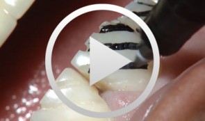 Ãsthetische Versorgung von Frontzähnen mit keramischen Laminate Veneers