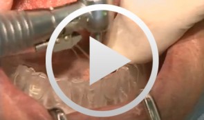 Implants for the Anterior Maxillary Region