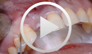 Implantologische Versorgung mit Soft- und Hard-Tissue-Management