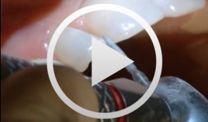 Incremental layering composite restoration in the anterior maxilla