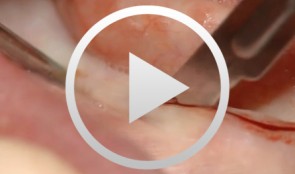 Immediately loaded implant restorations in the edentulous mandible