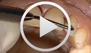 Surgical Treatment of Periodontitis Using a Minimally Invasive Approach