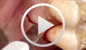 Gesteuerte Knochenregeneration mit Membrantechnik im OK-Seitenzahnbereich. Insertion eines Implantats - Der komplette Fall