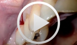 Piezo Surgery Technique for Alveolar Ridge Augmentation with Sinus Lift