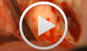 Microsurgical Removal of a Foreign Body from the Mandibular Canal