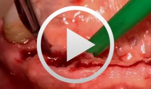 Treatment of the Edentulous Mandible with an Immediately Loaded Screw-retained Fixed Restoration - The entire case