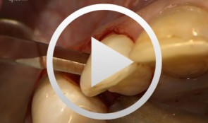 Regenerative Measures for Osseous Defect Repair and Optimal Esthetics
