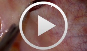 Regenerative Procedures for Optimized Esthetics at Tooth 11