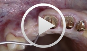 Implantation mit gleichzeitiger Augmentation