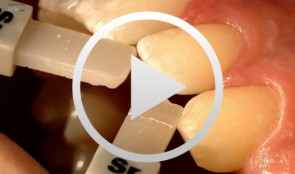 Composite Restoration in Anterior Teeth