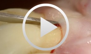 Flap designs for Interdental Tissue Preservation in Periodontal Therapy