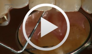 Incisal Edge Restoration and Repair