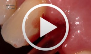 Implantation mit Sofortversorgung OK Regio 12