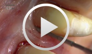 The Carnevale Technique: Hemisection/Trisection of Molars with Furcation Involvement