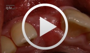 Implantatfreilegung mit Rolllappentechnik und Bindegewebetransplantation im Frontzahnbereich