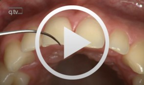 Gap Closure with a Minor Incisal Edge Restauration