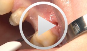 Internal Sinus Lift with the Lift Control System