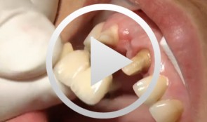 Implant-borne restorations (3rd edition)