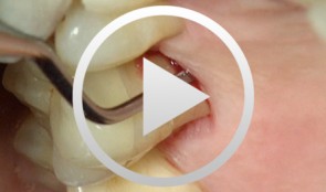 PSI - the Periodontal Screening Index