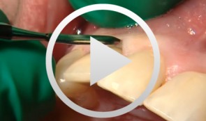 Implantatgetragener Zahnersatz (Ästhura Implants) und Kronen aus Zirkoniumdioxid
