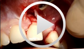Knochenaugmentation mit autologem Knochen