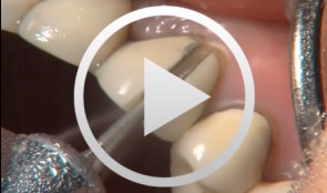 Preparation of Crowns and Bridges