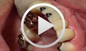 Implantatgetragener Zahnersatz, Knochenaugmentation und Weichgewebstransplantat