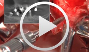 Bone Spreading, Bone Condensing (Interim Control System)