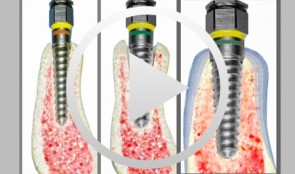 Split Control System, Spreading am Modell und am Patienten